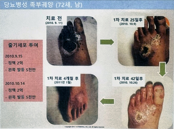 4_당뇨병성족부궤양.jpg