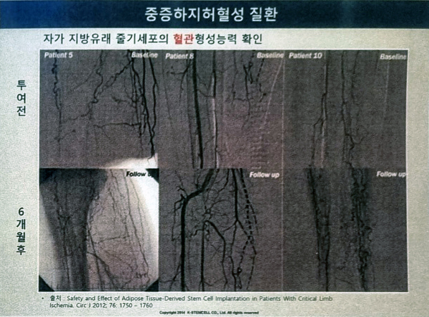 4_중증하지허혈성질환.jpg